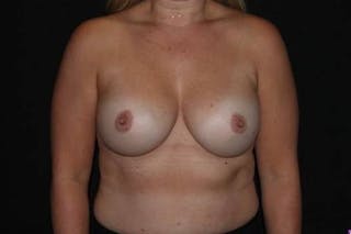 Breast Augmentation Silicone Gel Before & After Gallery - Patient 976078 - Image 2