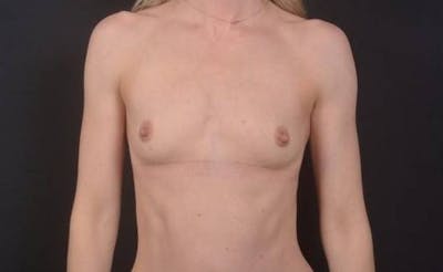Breast Augmentation Silicone Gel Before & After Gallery - Patient 395071 - Image 1