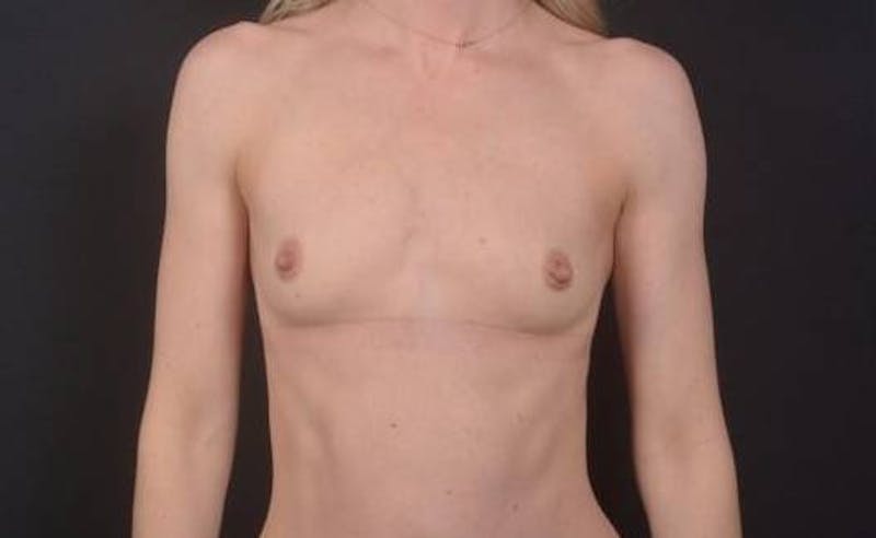 Breast Augmentation Silicone Gel Before & After Gallery - Patient 395071 - Image 1