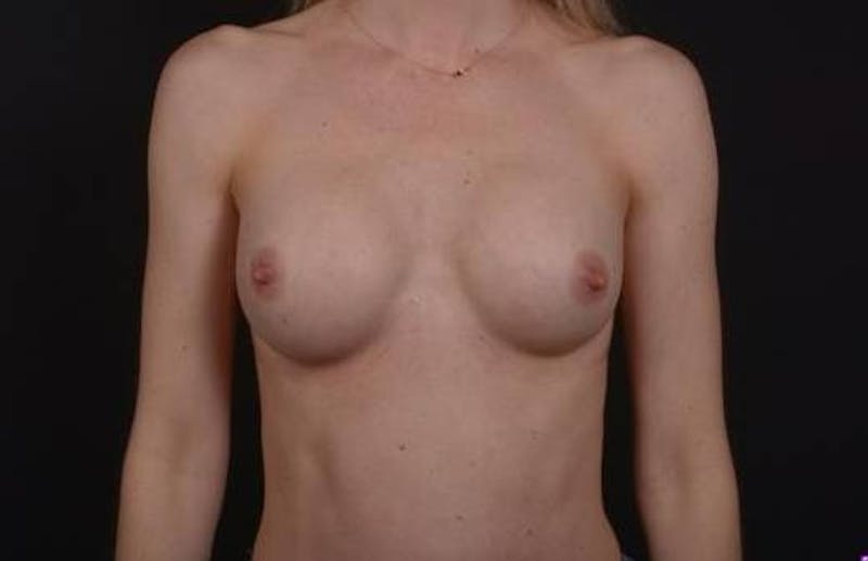 Breast Augmentation Silicone Gel Before & After Gallery - Patient 395071 - Image 2