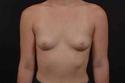 Breast Augmentation Silicone Gel Before & After Gallery - Patient 387690 - Image 1