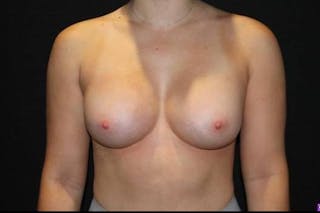 Breast Augmentation Silicone Gel Before & After Gallery - Patient 387690 - Image 2