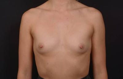 Breast Augmentation Silicone Gel Before & After Gallery - Patient 285636 - Image 1