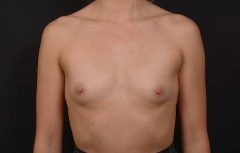 Breast Augmentation Silicone Gel Before & After Gallery - Patient 285636 - Image 1