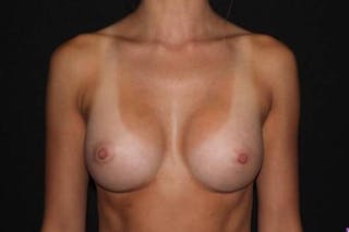 Breast Augmentation Silicone Gel Before & After Gallery - Patient 285636 - Image 2