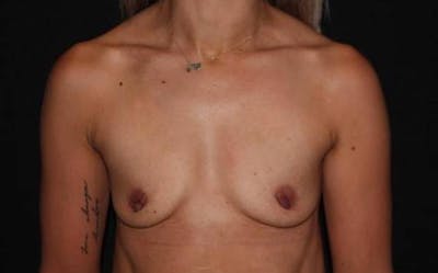 Breast Augmentation Silicone Gel Before & After Gallery - Patient 191707 - Image 1
