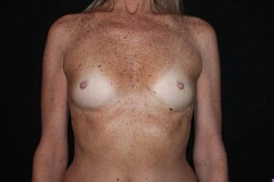 Breast Augmentation Silicone Gel Before & After Gallery - Patient 209779 - Image 1