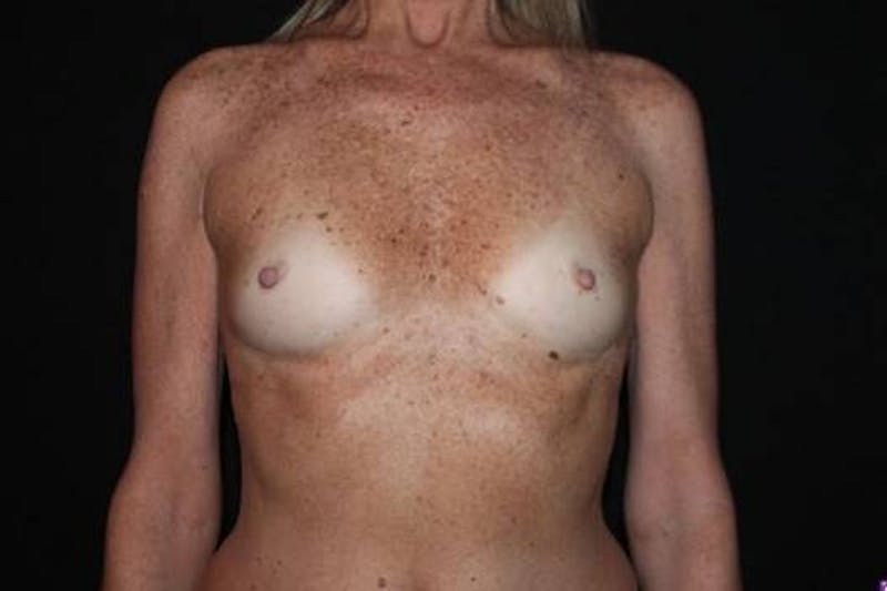 Breast Augmentation Silicone Gel Before & After Gallery - Patient 209779 - Image 1