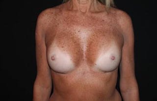 Breast Augmentation Silicone Gel Before & After Gallery - Patient 209779 - Image 2