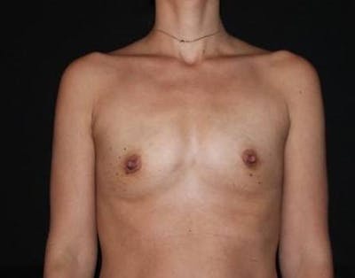Breast Augmentation Silicone Gel Before & After Gallery - Patient 319350 - Image 1