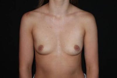 Breast Augmentation Silicone Gel Before & After Gallery - Patient 680962 - Image 1