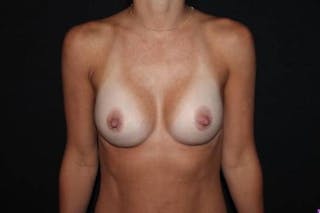 Breast Augmentation Silicone Gel Before & After Gallery - Patient 318730 - Image 2