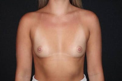 Breast Augmentation Silicone Gel Before & After Gallery - Patient 186637 - Image 1