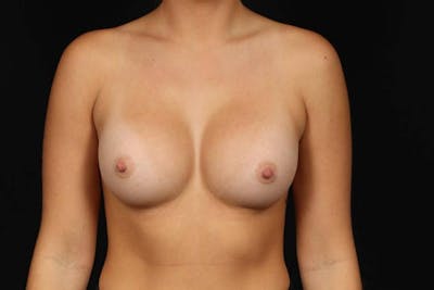 Breast Augmentation Silicone Gel Before & After Gallery - Patient 186637 - Image 2