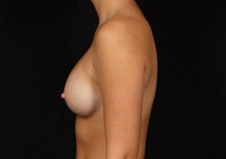 Breast Augmentation Silicone Gel Before & After Gallery - Patient 186637 - Image 6