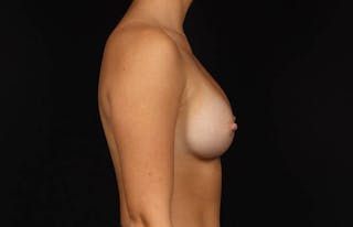 Breast Augmentation Silicone Gel Before & After Gallery - Patient 186637 - Image 10