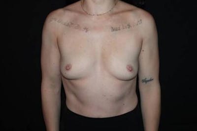 Breast Augmentation Silicone Gel Before & After Gallery - Patient 390702 - Image 1