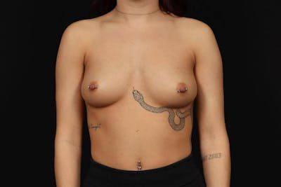 Breast Augmentation Silicone Gel Before & After Gallery - Patient 279923 - Image 1