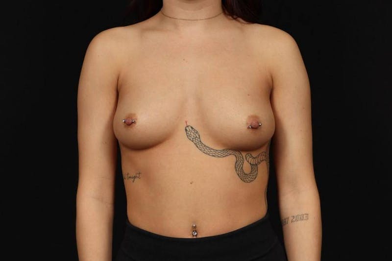 Breast Augmentation Silicone Gel Before & After Gallery - Patient 279923 - Image 1