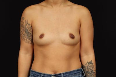 Breast Augmentation Silicone Gel Before & After Gallery - Patient 356162 - Image 1