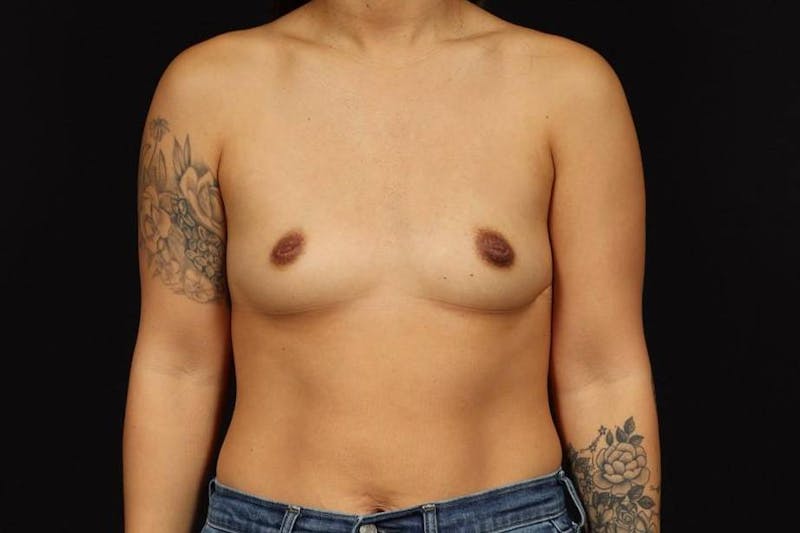 Breast Augmentation Silicone Gel Before & After Gallery - Patient 356162 - Image 1