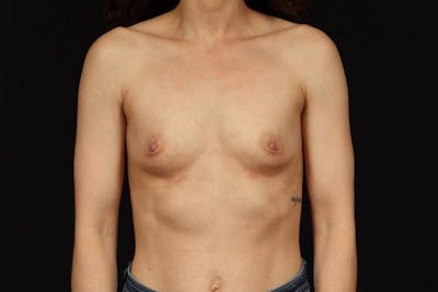 Breast Augmentation Silicone Gel Before & After Gallery - Patient 129157 - Image 1