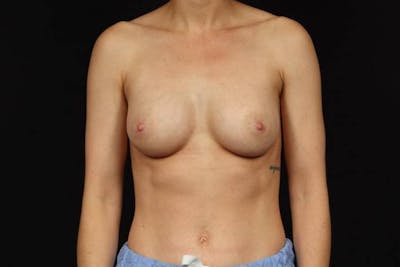Breast Augmentation Silicone Gel Before & After Gallery - Patient 129157 - Image 2