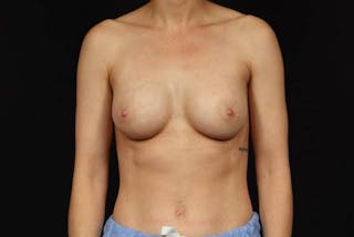 Breast Augmentation Silicone Gel Before & After Gallery - Patient 129157 - Image 2
