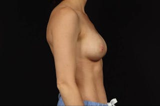 Breast Augmentation Silicone Gel Before & After Gallery - Patient 129157 - Image 10