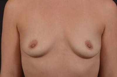 Breast Augmentation Silicone Gel Before & After Gallery - Patient 134470 - Image 1