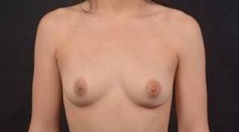 Breast Augmentation Silicone Gel Before & After Gallery - Patient 422098 - Image 1