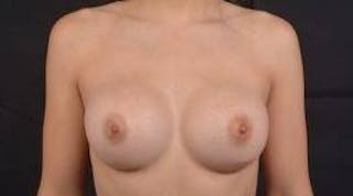 Breast Augmentation Silicone Gel Before & After Gallery - Patient 422098 - Image 2
