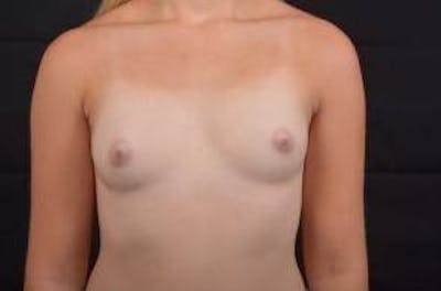 Breast Augmentation Silicone Gel Before & After Gallery - Patient 110850 - Image 1