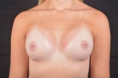 Breast Augmentation Silicone Gel Before & After Gallery - Patient 110850 - Image 2