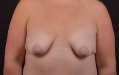 Breast Augmentation Silicone Gel Before & After Gallery - Patient 111835 - Image 1