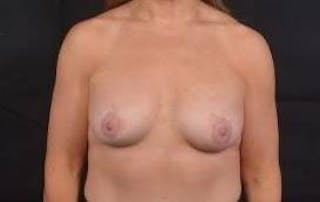 Breast Augmentation Silicone Gel Before & After Gallery - Patient 111835 - Image 2
