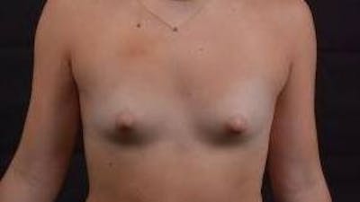 Breast Augmentation Silicone Gel Before & After Gallery - Patient 117081 - Image 1