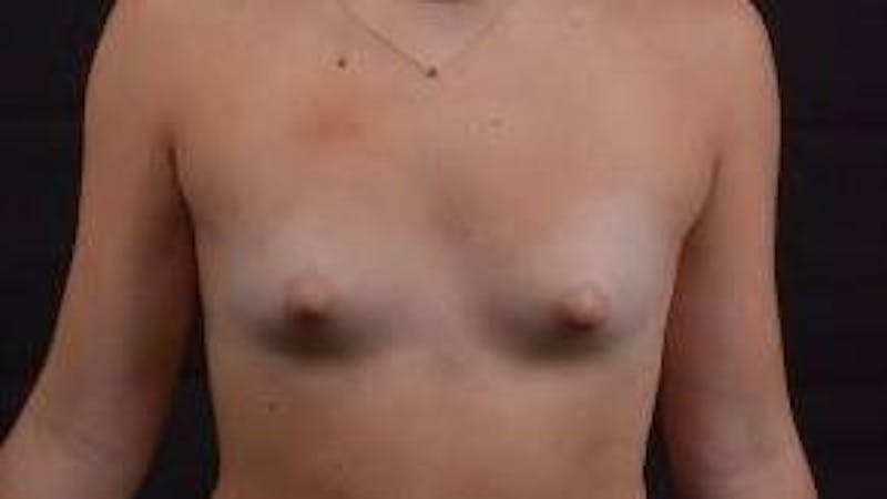 Breast Augmentation Silicone Gel Before & After Gallery - Patient 117081 - Image 1