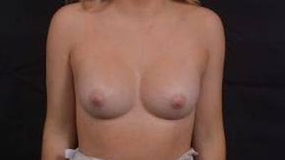 Breast Augmentation Silicone Gel Before & After Gallery - Patient 117081 - Image 2