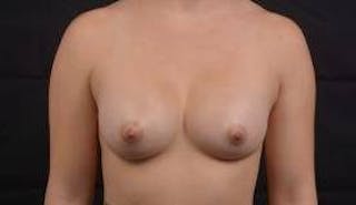 Breast Augmentation Silicone Gel Before & After Gallery - Patient 175424 - Image 2