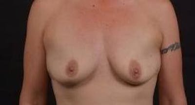 Breast Augmentation Silicone Gel Before & After Gallery - Patient 745021 - Image 1