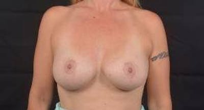 Breast Augmentation Silicone Gel Before & After Gallery - Patient 745021 - Image 2