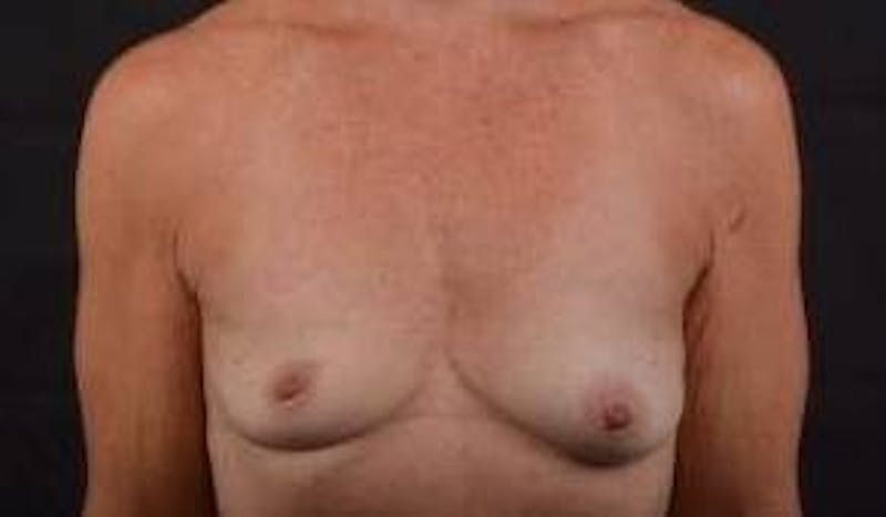 Breast Augmentation Silicone Gel Before & After Gallery - Patient 957999 - Image 1