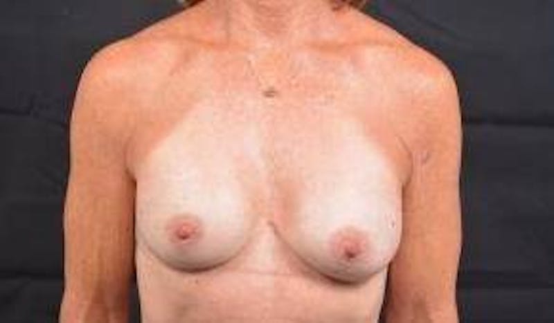 Breast Augmentation Silicone Gel Before & After Gallery - Patient 957999 - Image 2