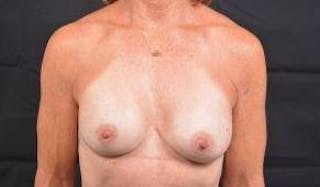 Breast Augmentation Silicone Gel Before & After Gallery - Patient 957999 - Image 2