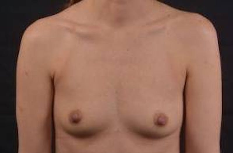 Breast Augmentation Silicone Gel Before & After Gallery - Patient 903878 - Image 1