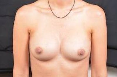 Breast Augmentation Silicone Gel Before & After Gallery - Patient 903878 - Image 2