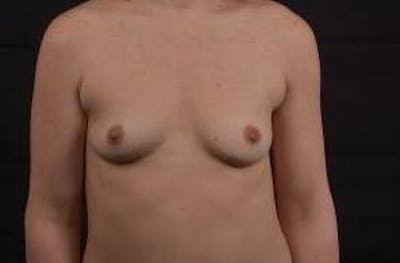 Breast Augmentation Silicone Gel Before & After Gallery - Patient 327039 - Image 1