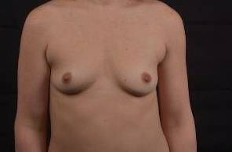Breast Augmentation Silicone Gel Before & After Gallery - Patient 327039 - Image 1