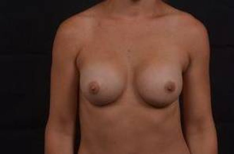 Breast Augmentation Silicone Gel Before & After Gallery - Patient 327039 - Image 2